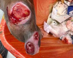 Cleaning diabetic patient’s foot wound