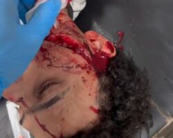 Deep wound on face caused by machete