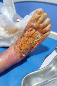 Diabetic foot surgery