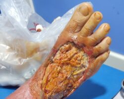 Diabetic foot surgery