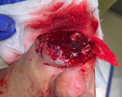 His dog ate his big toe while he was sleeping