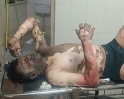 Indian guy suffered severe burns from suicide attempt