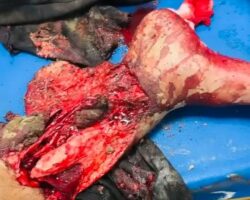 Initial painful treatment of injured legs after motorcycle accident
