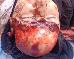 Iraqi man scalped in work accident