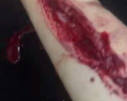 Mentally ill teenage girl cuts into her thigh