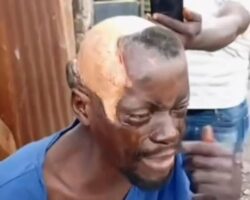 Victim of acid attack in Nigeria