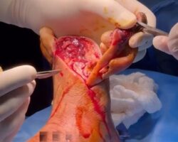 Amputation of toes due to diabetes