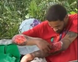 Drug-addicted homeless man with open wound on his arm