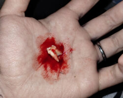 Dude ripped out his own tooth at home