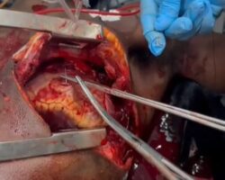 Emergency cardiac surgery saved patient’s life