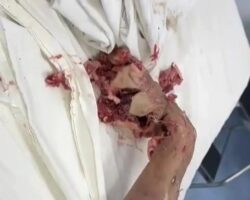 Female meat market employee lost her hand in meat grinder