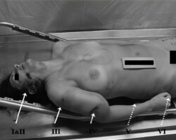 Female victim of car crash in morgue