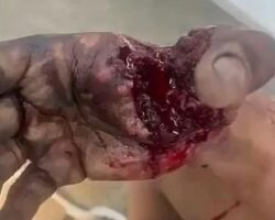 Fireworks tore his hand