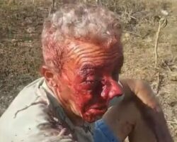 Motorcycle accident nearly tore off man’s nose