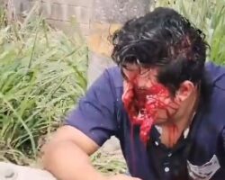 Motorcyclist tore his face open in crash