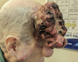 Patient with extensive facial cancer