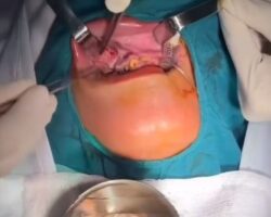 Removal of larvae from mouth of patient with oral myiasis