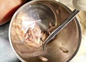 Removal of larvae from mouth of patient with oral myiasis