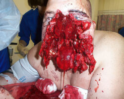 Destroyed face after motorcycle accident