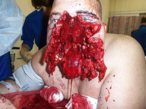 Destroyed face after motorcycle accident