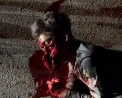 Face destroyed in motorcycle accident