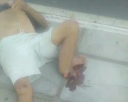 Guy lost his foot in motorcycle accident