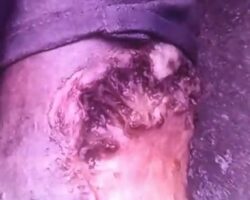 Homeless man being eaten alive by maggots