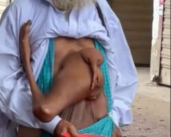 Indian man suffering from abnormality of parasitic twin