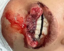 Man bit off his girlfriend’s lower lip