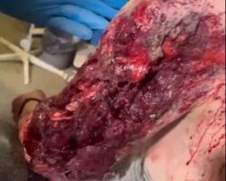 Russian badly injured by shrapnel