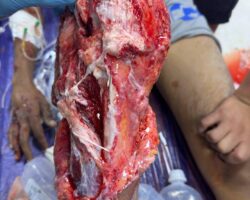 Surgical leg treatment after motorcycle accident