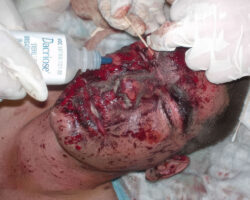 War injuries of soldiers from war in Iraq
