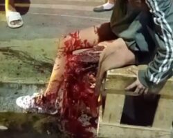 Leg destroyed after collision with truck