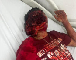 Motorcyclist tore his face in crash