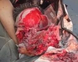 Shattered head as result of traffic accident