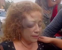 Woman with hematoma on face after being hit by car