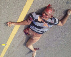 Collision with car tore off pedestrian’s entire leg