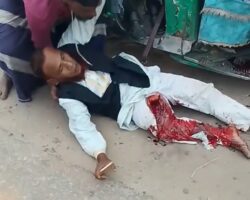 Crushed leg after collision with rickshaw