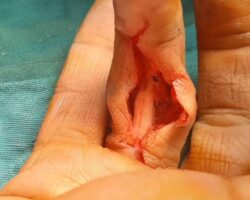 MIX: Injuries caused by knife