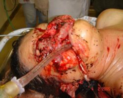 Woman mutilated by own pitbull