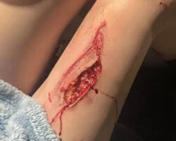 Young Vietnamese woman suffered leg injury in moped crash