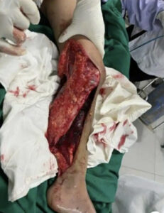 Boy fell under truck while running away from stray dog