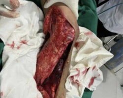 Boy fell under truck while running away from stray dog