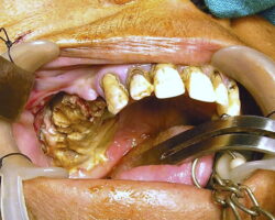 Massive necrosis after tooth extraction