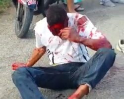 Motorcycle crash left his face badly mutilated