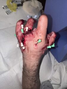 Playing with fireworks ended in blown off fingers