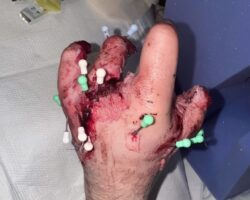 Playing with fireworks ended in blown off fingers