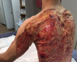 Severe burns caused by moped crash