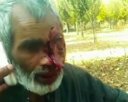 Severely ripped face caused by traffic accident