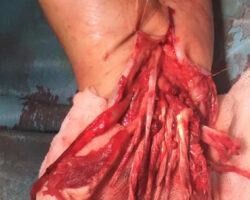 Woman mutilated and chewed her own forearm